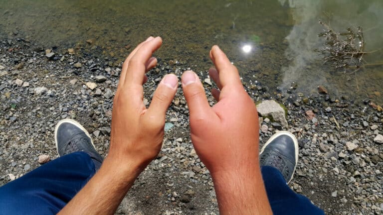 Find Out Why Your Hands Might Swell When Hiking